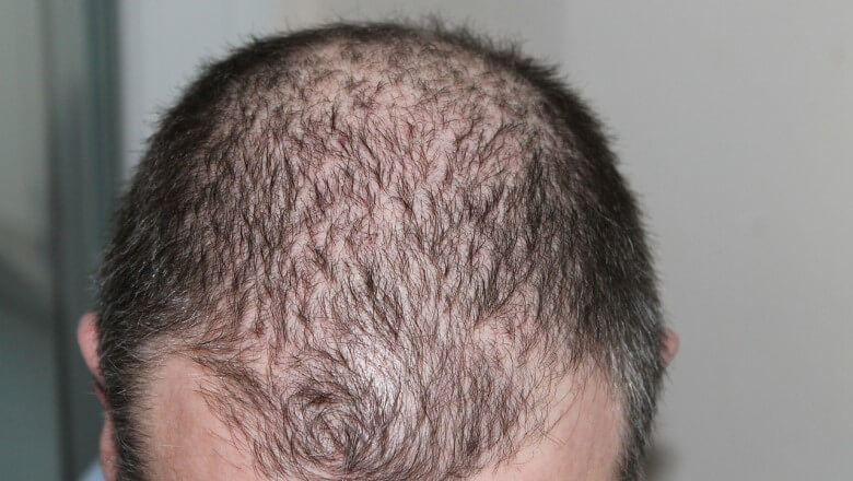 Haarausfall Männer: Diffuser Haarausfall bei Männern