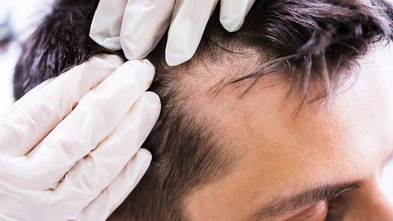 Haarausfall Männer: Untersuchung beim Facharzt