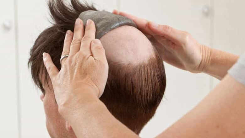 Haarausfall Männer: Hilfe durch ein Toupet