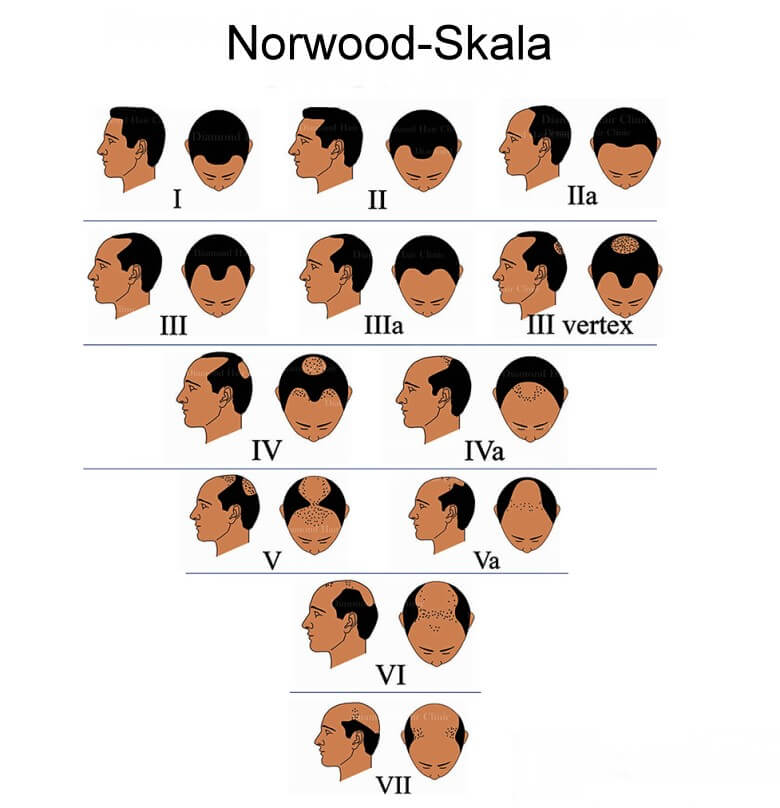 Glatzenbildung auf der Norwood-Skala