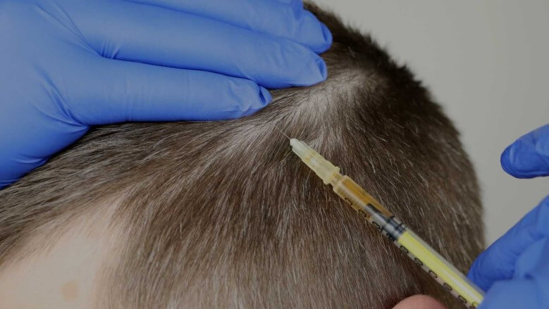 Mittel gegen Haarausfall: Injektion in die Kopfhaut