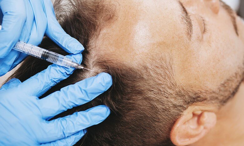 Mittel gegen Haarausfall: Die Mesotherapie
