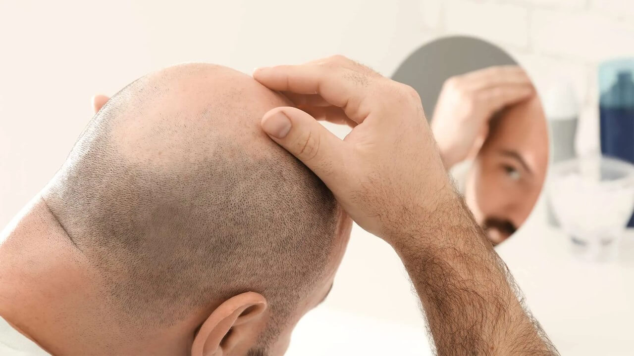 Mythen über Haarausfall und Haartransplantationen