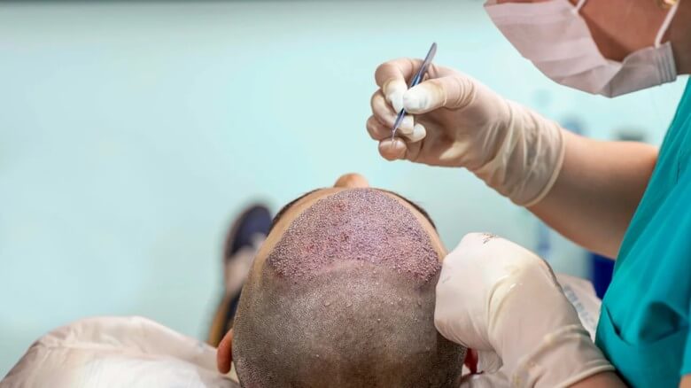 Haartransplantation-Operation