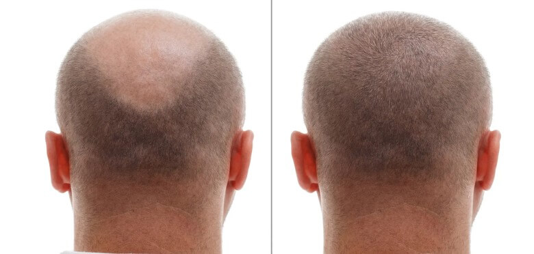 Fragen zur Haartransplantation