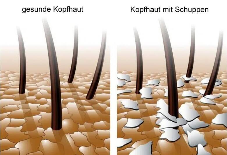 Vergleich gesunde Kopfhaut und Kopfhaut mit Schuppen