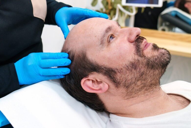 Ablauf einer Haartransplantation