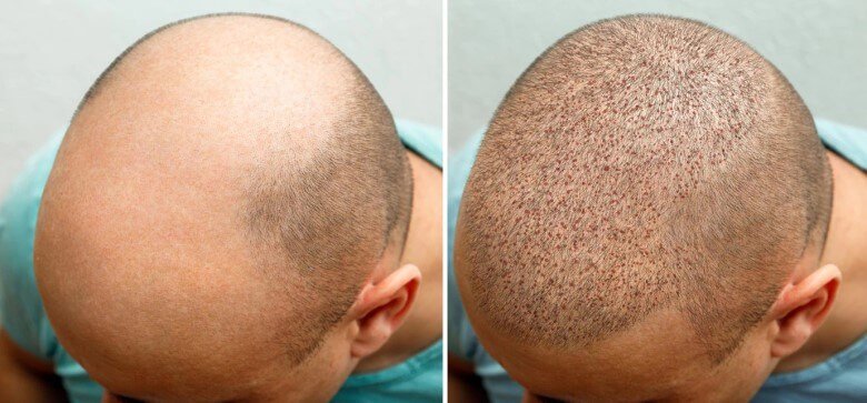 FUE Haartransplantation - Vorher-Nachher