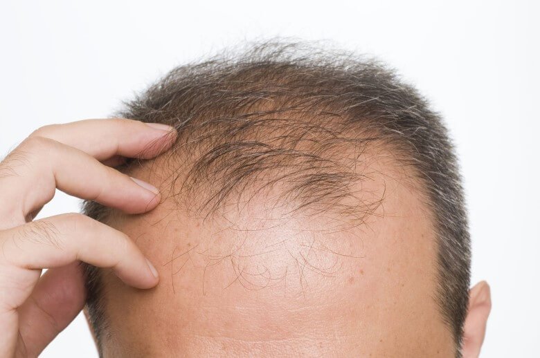 Welche Haartransplantation Methode ist 2026 die beste?