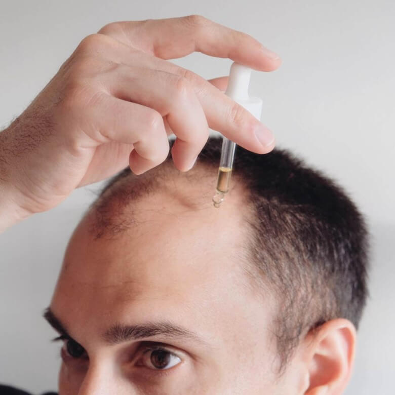 Haartransplantation Alternativen - Minoxidil