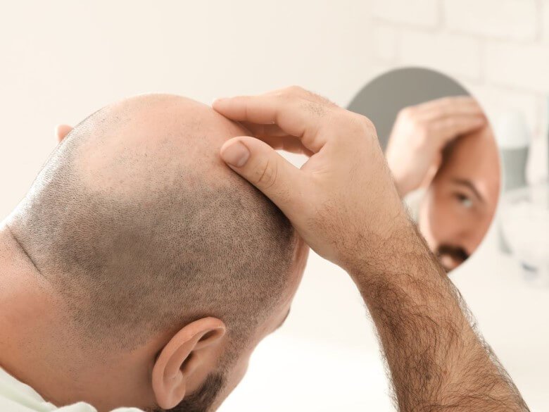 Risiken und Nebenwirkungen einer Haartransplantation
